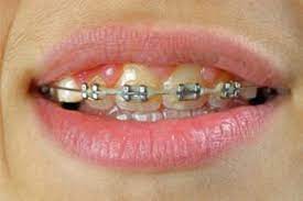They will whiten by delivering concentrations of carbamide peroxide into surface enamel to break up stains. How To Whiten Teeth With Braces Howstuffworks