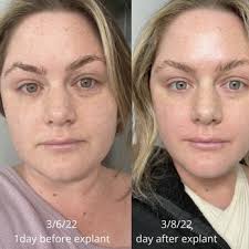 KEVIN BRENNER, MD FACS