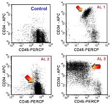 Flow Cytometric Analysis Of Leukemia And Lymphoma The Basics