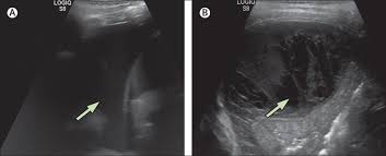 A pneumonia outbreak associated with a new coronavirus of probable bat origin. Complicated Pneumonia In Children The Lancet