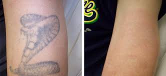 Before And After Laser Tattoo Removal Pictures Pristine Laser Center Orlando