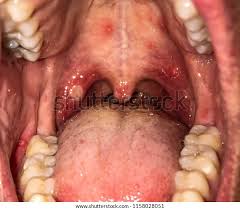 Image result for Oral herpes roof of mouth