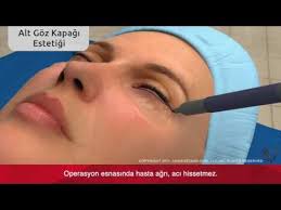 Alt Goz Kapagi Blefaroplasti Ameliyati Videosu Bursa Youtube