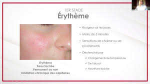 L'acné sévère n'est pas une fatalité. Comprendre La Rosacee Et L Acne Rosacee Et La Peau Sensible D Une Perspective Medico Esthetique Youtube