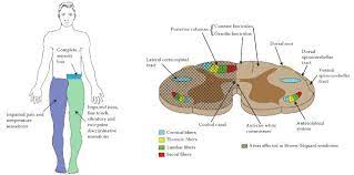 Brown Sequard Syndrome Anatomical Basis Epomedicine
