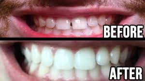 Some candle wax or petroleum jelly or even your lip balm (colorless) can do the trick. Politicky Lozisko Definitivni How To Make A Gap In Your Teeth Kampus Hrat Spanek