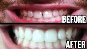 Read our guide on how to straighten teeth without braces. How To Fill Gap In Teeth Naturally Teethwalls