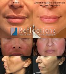 Image result for Melasma
