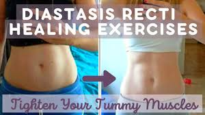 Diastasis Recti Healing Exercises Part 1 Tighten Tummy Muscles After Baby Youtube