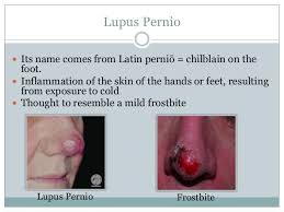 It presents as a violaceous lesion or shiny nodules over the head and neck but predominantly localized to the nose, cheeks, and ears. Lupus Pernio