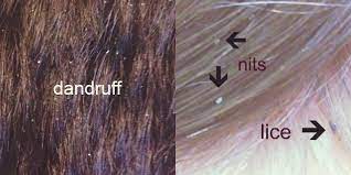 This is one of the more popular shades of brown hair color right now. Lice Vs Dandruff Nits Dry Scalp What S The Difference Guide