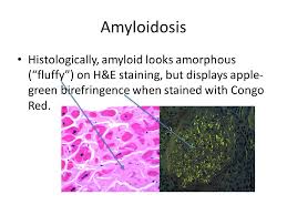 H & e stain showing diffuse acellular, eosinophilic material in the conjunctiva. Amyloidosis When Good Proteins Go Bad Ppt Video Online Download