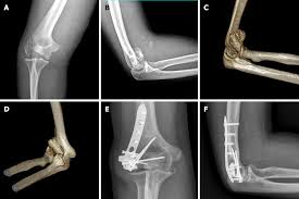 Image result for Lateral Condyle Fracture