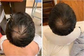 Prp Hair Treatment Results Regene Spine