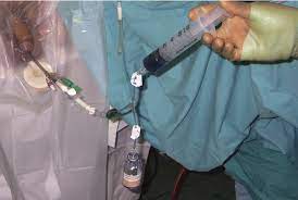 Immediate Administration Of Intravesical Mitomycin C After Tumour Resection For Superficial Bladder Cancer Mostafid 2006 Bju International Wiley Online Library