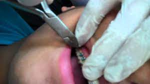 You can use a cotton swab or eraser to help move the wire. How To Cut The Long Wire On Braces Youtube