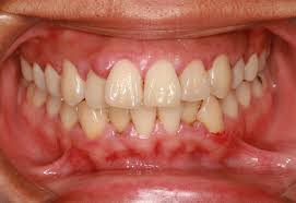 Tipos de enfermedades periodontales: gingivitis y periodontitis |  Clinicaartem.com