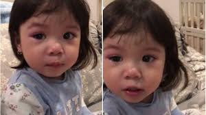 Mata Gempi Bengkak, Gisell Lakukan Berbagai Cara Pengobatan Hingga Sharing  dengan Netizen