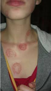 Tinea Corporis Tedavisi Kadinlar Kulubu