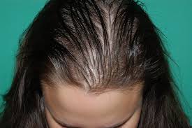 My thinning hair has been a continuous challenge for me ever since i started styling my hair myself in my early teen years. Hair Loss Treatment For Women Chicago Il Chicago Hair Institute