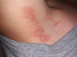 Hinter den ohren und an der halsseite treten rote, unregelmäßige flecken auf, die bald verschmelzen und den. Ausschlag Die Meistgelesenen Fragen