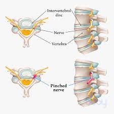 Pinched Nerve | Causes, Symptoms, And How To Get Relief