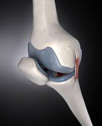 There is usually no swelling. Knee Ligament Injuries Tear Sprained Knee Ligament Sprain Physio