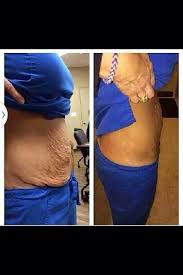 I Am Asked All The Time And The Answer Is Yes Our Wraps Tone Tighten And Firm Loose Skin Have You Had A Baby Saggy Skin Loose Belly Skin Tightening Cream