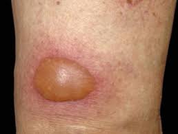 Fixed Drug Eruption Dermnet Nz