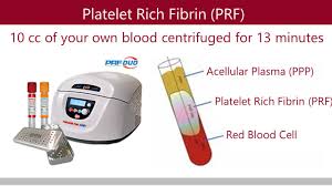 K ´ x ® y. Prf Stem Cells Aria Dental Mission Viejo Ca