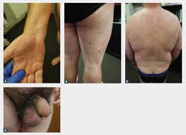 Image result for scabies on genitals
