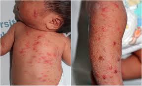 Image result for scabies human children