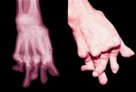 Foglietto illustrativo soldesam ung 30g 0,2. Soldesam Gocce Antinfiammatorio Per L Artrite