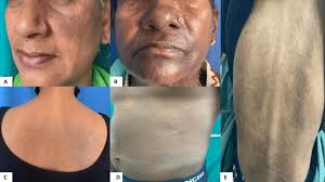 Image result for Diffuse Hyperpigmentation