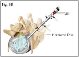 A slipped disc (also known as intervertebral disc herniation) is the most common cause of paralysis in dogs, but cats are much less often affected. Slipped Disc Faqs Spine Doctor Articles Asia Medical Specialists
