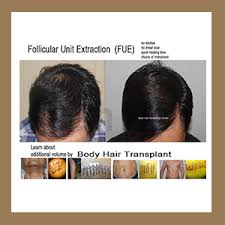 Our hair comprises one of the most essential features of our body that defines us. Body Hair Transplant Asian Hair Restoration Center