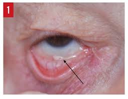 Ectropion: Classification, Diagnosis ...