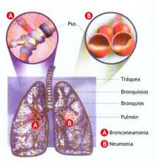 Neumonia causada por neumococos