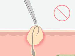 How To Get Rid Of Ingrown Pubic Hair With Pictures Wikihow