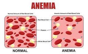 Anemia: Meaning, Symptoms, and Types