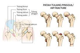 Pada persendian pinggul terdapat bantalan tulang rawan yang membantu mencegah gesekan saat tulang pinggul bergerak. Patah Tulang Pinggul Gejala Penyebab Dan Mengobati Alodokter