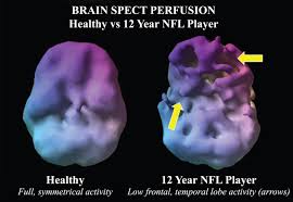 Cte is a degenerative brain disease believed to be caused by repeated blows to the head. Repetitive Head Trauma Leads To Nfl Players Brain Damage Amen Clinics