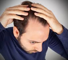 Sac Cikaran Kur Hair Loss Men Hair Loss Remedies Hair Loss Treatment