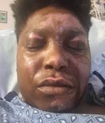 The Sweet Sound of Recovery: A Burn Patient Plays Again