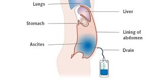 There are ways to find out if you have to see a doctor immediately and even tips how to remove fluid from lungs naturally. Paracentesis For Mesothelioma Procedure Risks