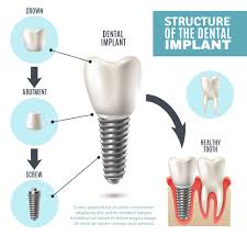 That begs the question, how much do dental implants cost and are you really getting good value two of the most common options for replacing a missing tooth or teeth are dental implants and it's up to you to decide if you want to pay a higher price up front for replacement teeth that will last a long. Dental Implant Clinic In Abu Dhabi Uae Same Day Dental Implants