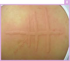 Image result for Dermatographism