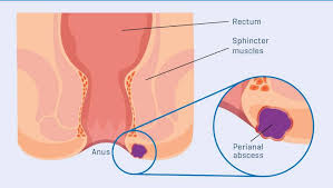 Image result for Perianal Abscess