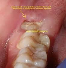 Maybe you would like to learn more about one of these? Wisdom Teeth Removal Cost In India Teethwalls