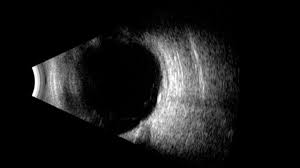 Image result for lesion sclera